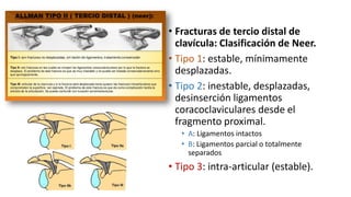 • Fracturas de tercio distal de
clavícula: Clasificación de Neer.
• Tipo 1: estable, mínimamente
desplazadas.
• Tipo 2: inestable, desplazadas,
desinserción ligamentos
coracoclaviculares desde el
fragmento proximal.
• A: Ligamentos intactos
• B: Ligamentos parcial o totalmente
separados
• Tipo 3: intra-articular (estable).
 