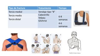 Tipo de fractura Tratamiento Tiempo
Tercio medial Vendaje tipo “8”
Cabestrillo
Velpau
Gilchrist
Tercio medio 6-8
semanas
Tercio distal
4-6
semanas
 