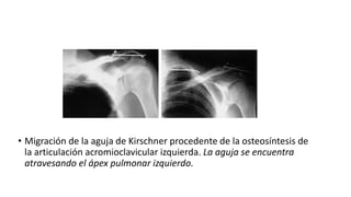 • Migración de la aguja de Kirschner procedente de la osteosíntesis de
la articulación acromioclavicular izquierda. La aguja se encuentra
atravesando el ápex pulmonar izquierdo.
 
