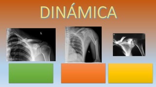 Fx de clavícula
Tercio medio
Tx conservador
Fx de clavícula
Tercio distal
Tx conservador
Fx de clavícula
Tercio medio con luxación
acromioclavicular
Tx quirurgico
 