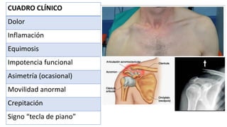 CUADRO CLÍNICO
Dolor
Inflamación
Equimosis
Impotencia funcional
Asimetría (ocasional)
Movilidad anormal
Crepitación
Signo “tecla de piano”
 