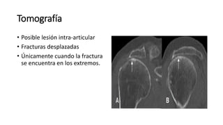 Tomografía
• Posible lesión intra-articular
• Fracturas desplazadas
• Únicamente cuando la fractura
se encuentra en los extremos.
 