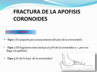 Fractura de codo | PPTX