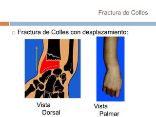 Fractura De Colles PPTX fractura-de-colles-pptx