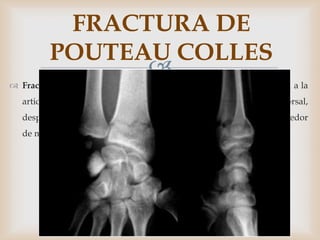 FRACTURA DE
          POUTEAU COLLES
                
 Fractura de Colles: se localiza a una distancia de 2 a 5 cm proximal a la
   articulación de la muñeca y se asocia con angulación dorsal,
   desplazamiento radial y acortamiento distal con deformación en tenedor
   de mesa.
 