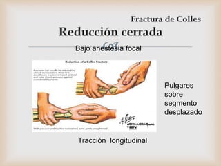 Bajo anestesia focal
Pulgares
sobre
segmento
desplazado
Tracción longitudinal
 