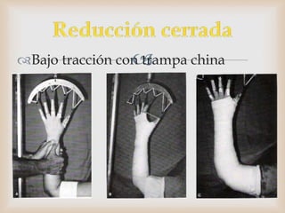 Bajo tracción con trampa china
 
