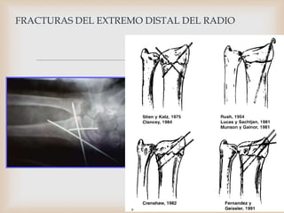 
FRACTURAS DEL EXTREMO DISTAL DEL RADIO
 