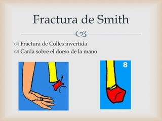 
Fractura de Smith
 Fractura de Colles invertida
 Caída sobre el dorso de la mano
 