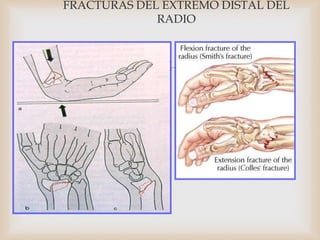 
FRACTURAS DEL EXTREMO DISTAL DEL
RADIO
 