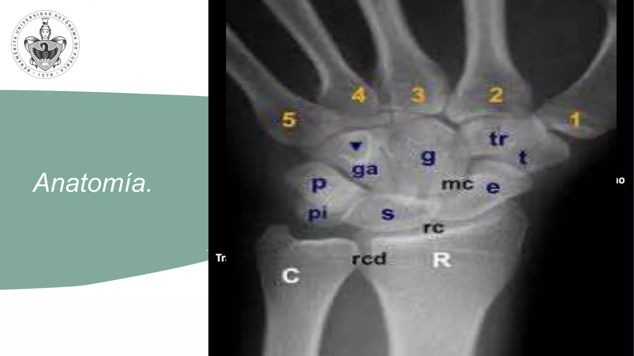 Colles Image Fractura de Colles.pptx