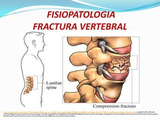 FISIOPATOLOGIA
                               FRACTURA VERTEBRAL




http://www.google.com.co/search?hl=es&psj=1&bav=on.2,or.r_qf.&bvm=bv.43287494,d.eWU&biw=1280&bih=656&um=1&ie=UTF-8&tbm=isch&source=og&sa=N&tab=wi&ei=wNg8UZOZC4PW9AS
c6IHQAQ&q=fractura%20de%20columna#imgrc=jFzsJlP_ksegQM%3A%3BJdFPdyVDb4MhZM%3Bhttp%253A%252F%252Fimg62.imageshack.us%252Fimg62%252F9154%252Ffracturadecolumna.jpg%3
Bhttp%253A%252F%252Fwww.friki.net%252Ffotos%252F32886-fracturas.html%3B372%3B231.
 