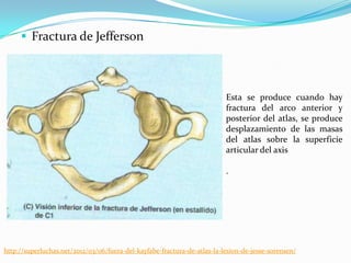  Fractura de Jefferson



                                                                          Esta se produce cuando hay
                                                                          fractura del arco anterior y
                                                                          posterior del atlas, se produce
                                                                          desplazamiento de las masas
                                                                          del atlas sobre la superficie
                                                                          articular del axis

                                                                          .




http://superluchas.net/2012/03/06/fuera-del-kayfabe-fractura-de-atlas-la-lesion-de-jesse-sorensen/
 