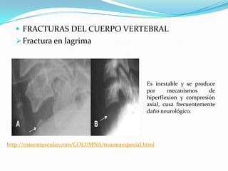  FRACTURAS DEL CUERPO VERTEBRAL
    Fractura en lagrima




                                                 Es inestable y se produce
                                                 por      mecanismos     de
                                                 hiperflexion y compresión
                                                 axial, cusa frecuentemente
                                                 daño neurológico.




http://osteomuscular.com/COLUMNA/traumaespecial.html
 