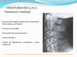  FRACTURAS DE C3 A C7
  Fractura en “teardrop”


Fractura del Angulo anterior por compresión
de la columna en flexión

Es severa e inestable

Protrusión del muro posterior

Lesión del disco

Lesión de ligamentos articulares e inter
espinosos




   http://www.authorstream.com/Presentation/radiologiamacarena-909422-fracturas-de-la-columna-cervical-carmen-prieto/
 
