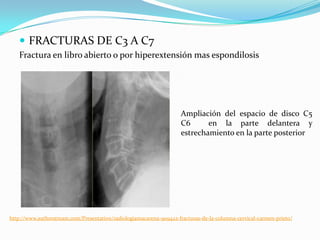  FRACTURAS DE C3 A C7
   Fractura en libro abierto o por hiperextensión mas espondilosis




                                                                     Ampliación del espacio de disco C5
                                                                     C6      en la parte delantera y
                                                                     estrechamiento en la parte posterior




http://www.authorstream.com/Presentation/radiologiamacarena-909422-fracturas-de-la-columna-cervical-carmen-prieto/
 