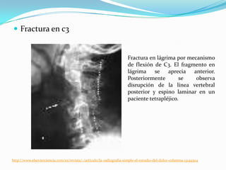  Fractura en c3


                                                                     Fractura en lágrima por mecanismo
                                                                     de flexión de C3. El fragmento en
                                                                     lágrima    se    aprecia  anterior.
                                                                     Posteriormente        se   observa
                                                                     disrupción de la línea vertebral
                                                                     posterior y espino laminar en un
                                                                     paciente tetrapléjico.




http://www.elsevierciencia.com/es/revista/-/articulo/la-radiografia-simple-el-estudio-del-dolor-columna-13149304
 