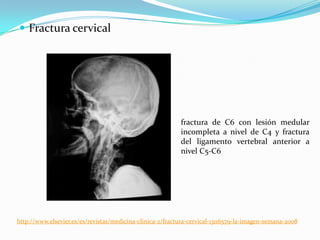  Fractura cervical




                                                           fractura de C6 con lesión medular
                                                           incompleta a nivel de C4 y fractura
                                                           del ligamento vertebral anterior a
                                                           nivel C5-C6




http://www.elsevier.es/es/revistas/medicina-clinica-2/fractura-cervical-13116579-la-imagen-semana-2008
 