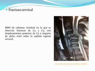  Fractura cervical




RMN de columna vertebral en la que se
observan fracturas de C4 y C5, con
desplazamiento posterior de C5 e impacto
de dicho nivel sobre la médula espinal
cervical.




                                           http://prestacionesneurosur.com/fractura-vertebrale/
 
