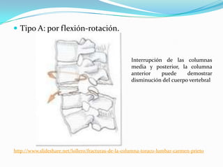  Tipo A: por flexión-rotación.



                                                    Interrupción de las columnas
                                                    media y posterior, la columna
                                                    anterior    puede     demostrar
                                                    disminución del cuerpo vertebral




http://www.slideshare.net/lollero/fracturas-de-la-columna-toraco-lumbar-carmen-prieto
 