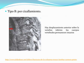  Tipo B: por cizallamiento.




                                               Hay desplazamiento anterior sobre la
                                               vertebra    inferior. los    cuerpos
                                               vertebrales permanecen intactos




http://www.slideshare.net/lollero/fracturas-de-la-columna-toraco-lumbar-carmen-prieto
 