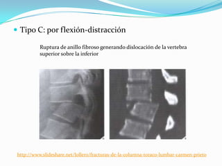  Tipo C: por flexión-distracción

           Ruptura de anillo fibroso generando dislocación de la vertebra
           superior sobre la inferior




 http://www.slideshare.net/lollero/fracturas-de-la-columna-toraco-lumbar-carmen-prieto
 