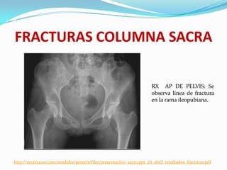 FRACTURAS COLUMNA SACRA

                                                                     RX AP DE PELVIS: Se
                                                                     observa línea de fractura
                                                                     en la rama ileopubiana.




http://seram2010.com/modules/posters/files/presentacion_sacro.ppt_26_abril_resultados_fracturas.pdf
 