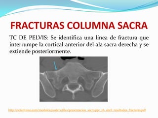 FRACTURAS COLUMNA SACRA
TC DE PELVIS: Se identifica una línea de fractura que
interrumpe la cortical anterior del ala sacra derecha y se
extiende posteriormente.




http://seram2010.com/modules/posters/files/presentacion_sacro.ppt_26_abril_resultados_fracturas.pdf
 