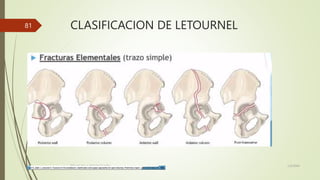 CLASIFICACION DE LETOURNEL
1/2/20XX
TÍTULO DE LA PRESENTACIÓN
81
 