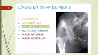 1/2/20XX
TÍTULO DE LA PRESENTACIÓN
85
Ortiz Alonso FJ. Vidan Astiz M, Marañón Fernández E. Evolución prospectiva de un programa de intervención geriátrica interdisciplinaria y secuencial en la recuperación funcional del anciano con
fractura de cadera. Trauma Fund Mapfre. 2008;19(1):13-21.
 