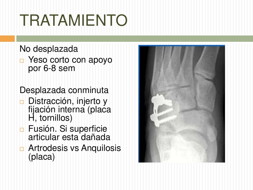 Fractura de cuboides y calcáneo