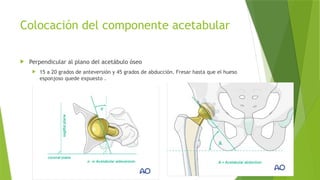 Fractura de cuello femoral Cadera Pelvis y Acetabulo | PPTX