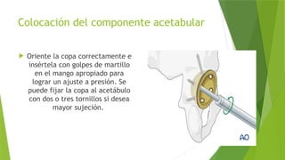 Fractura de cuello femoral Cadera Pelvis y Acetabulo | PPTX