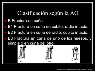 Clasificación según la AO





B Fractura en cuña
B1 Fractura en cuña de cubito, radio intacto.
B2 Fractura en cuña de radio, cubito intacto.
B3 Fractura en cuña de uno de los huesos, y
simple o en cuña del otro.

Algoritmo en el Tratamiento del Trauma Ortopédico - Alcívar

 
