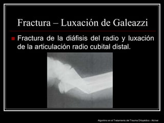 Fractura – Luxación de Galeazzi


Fractura de la diáfisis del radio y luxación
de la articulación radio cubital distal.

Algoritmo en el Tratamiento del Trauma Ortopédico - Alcívar

 