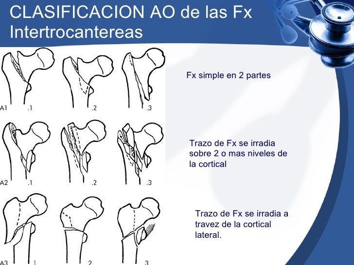 Fractura De Extremidades Inferiores