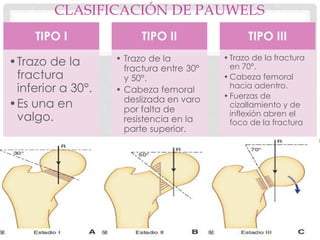 FRACTURA DE EXTREMO DE FEMUR FINAL pdf fractura-de-extremo-de-femur-final-pdf