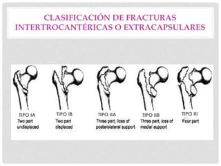 CLASIFICACIÓN DE FRACTURAS
INTERTROCANTÉRICAS O EXTRACAPSULARES
TIPO IA TIPO IB TIPO IIA TIPO IIB TIPO III
 