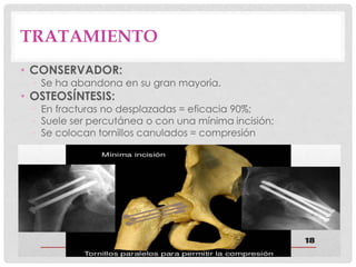 TRATAMIENTO
• CONSERVADOR:
• Se ha abandona en su gran mayoría.
• OSTEOSÍNTESIS:
• En fracturas no desplazadas = eficacia 90%;
• Suele ser percutánea o con una mínima incisión;
• Se colocan tornillos canulados = compresión
 
