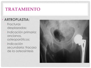 TRATAMIENTO
• ARTROPLASTIA:
• Fracturas
desplazadas;
• Indicación primaria:
ancianos,
osteoporóticos;
• Indicación
secundaria: fracaso
de la osteosíntesis
 