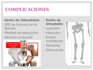 COMPLICACIONES
• Dentro de Osteosíntesis
• 30% de fracasos en la
fijación;
• Pérdida de reducción;
• Necrosis avascular.
• Dentro de
Artroplastia
• Luxación;
• Infección;
• Erosión
acetabular;
• Dismetría;
• Dislocación.
 