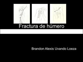 Fractura de húmero
Brandon Alexis Uvando Loeza
 