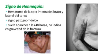 Signo de Hennequin:
▹Hematoma de la cara interna del brazo y
lateral del torax
▹signo patognomónico
▹suele aparecer a las 48 horas, no indica
en gravedad de la fractura
 