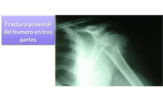 Fractura proximal
del húmero en tres
partes
 