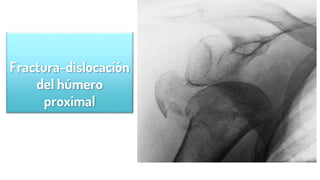 Fractura-dislocación
del húmero
proximal
 