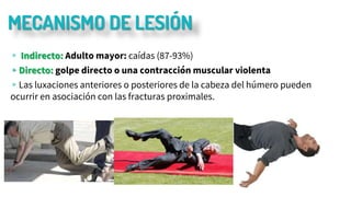 MECANISMO DE LESIÓN
▹ Indirecto: Adulto mayor: caídas (87-93%)
▹Directo: golpe directo o una contracción muscular violenta
▹Las luxaciones anteriores o posteriores de la cabeza del húmero pueden
ocurrir en asociación con las fracturas proximales.
 