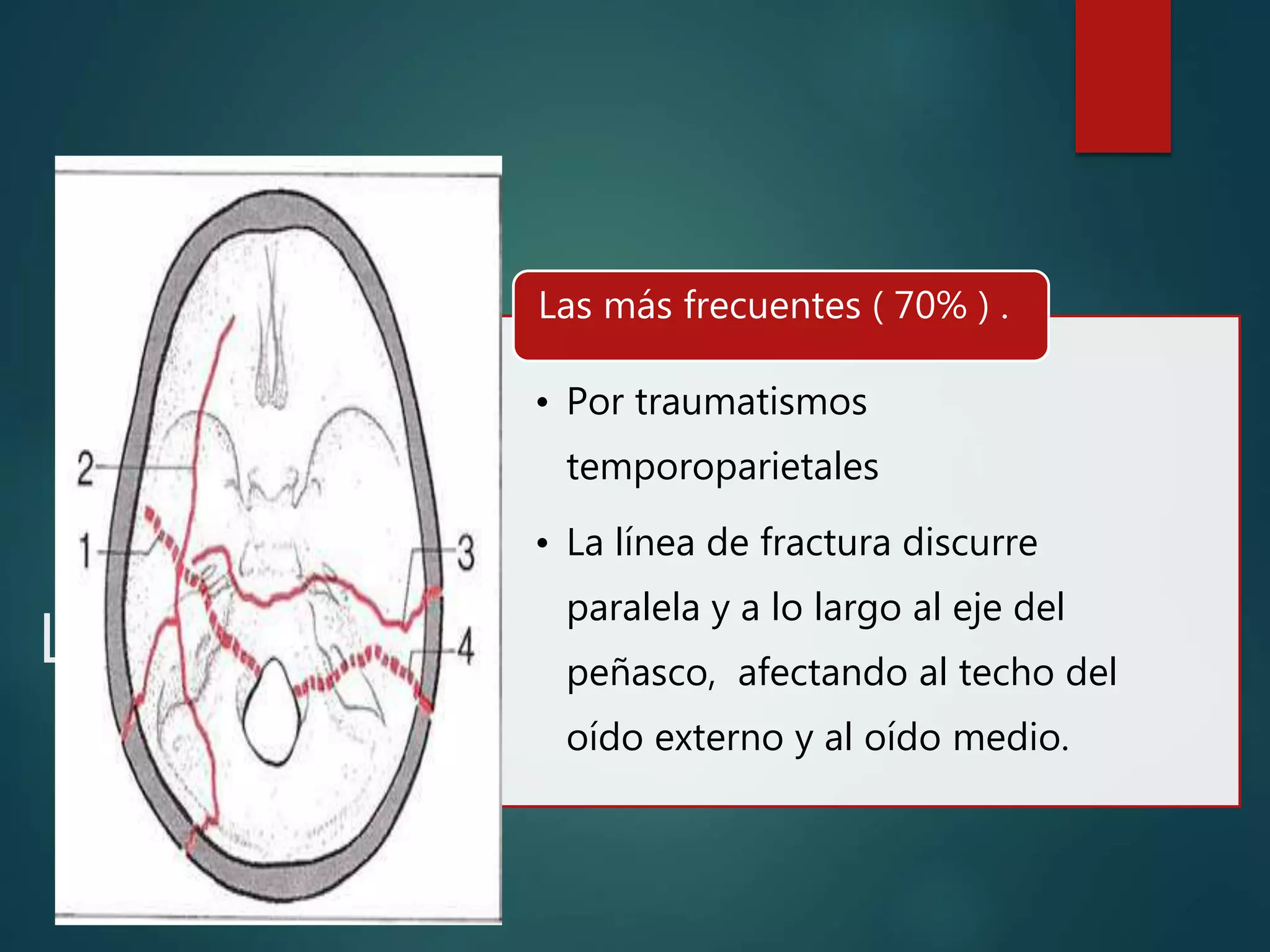 FRACTURA DE HUESO TEMPORAL DR OMAR GONZALES SUAZO PPTX Death fractura-de-hueso-temporal-dr-omar-gonzales-suazo-pptx-death