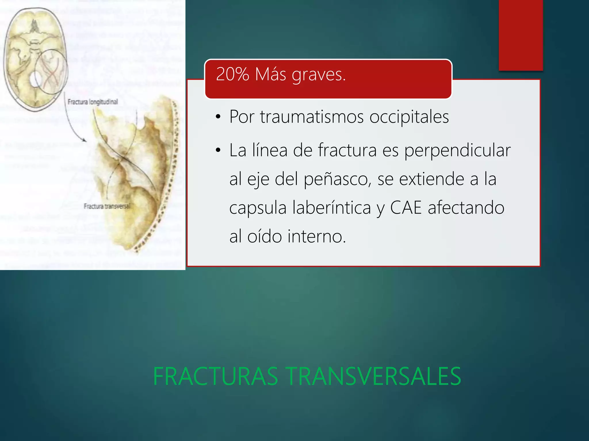 FRACTURA DE HUESO TEMPORAL DR OMAR GONZALES SUAZO PPTX Death fractura-de-hueso-temporal-dr-omar-gonzales-suazo-pptx-death