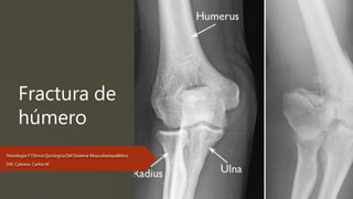 Fractura de
húmero
Nosología Y Clínica Quirúrgica Del Sistema Musculoesquelético
EM. Cabrera Carlos M
 