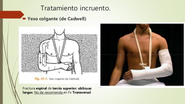 fracturas-de-humero